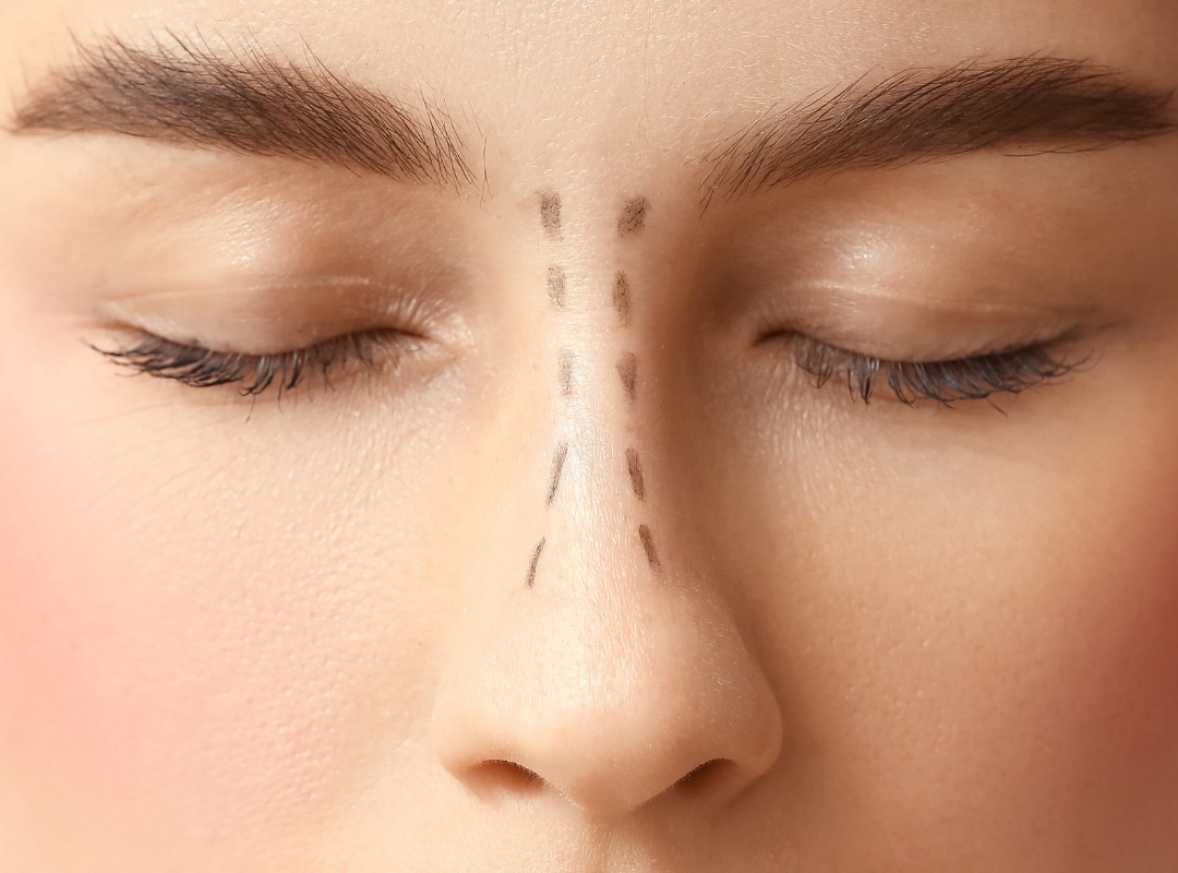 Rinoplastia Ultrassônica x Estruturada: Qual a Mais Indicada?