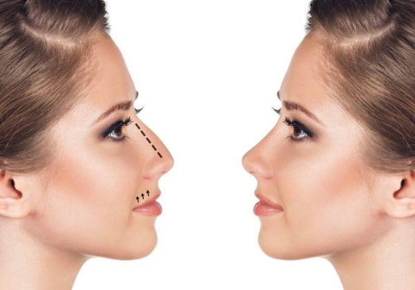 Rinoplastia Híbrida: Entenda o que é e seus benefícios para a estética nasal