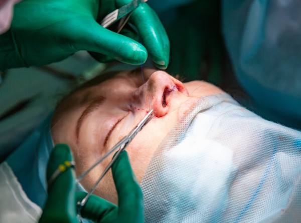 Rinoplastia Estruturada ou Preservadora? Qual é Melhor no Seu Caso?